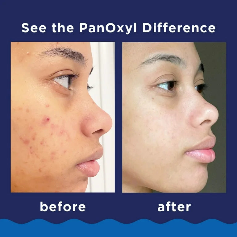Acne Foaming Wash 10% Benzoyl Peroxide Maximum Strength -Limpiador anti acne