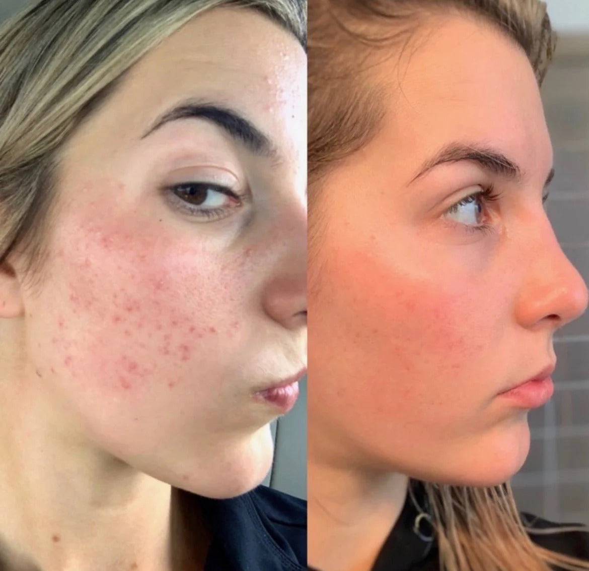 Retinol in Squalane