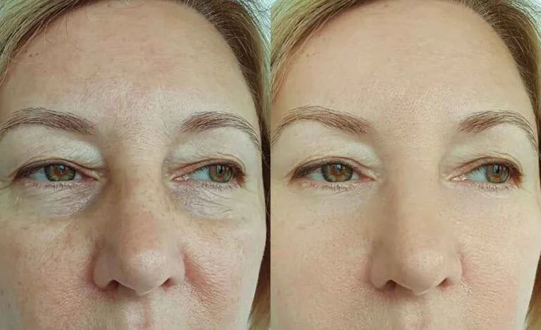 Salicylic Acid 2% Anhydrous Solution