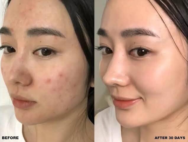 AHA 30% + BHA 2% Peeling Solution (TSuero exfoliante)