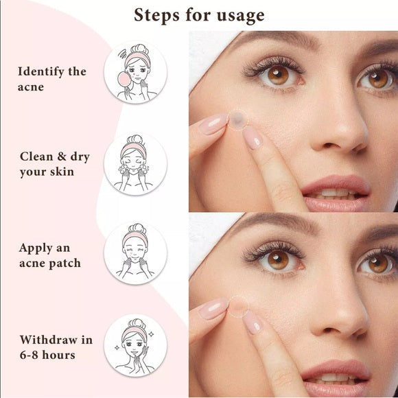 Acne treatment dots -30 pc
