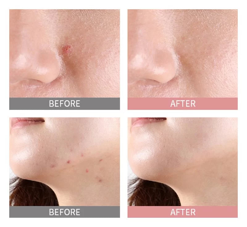 Acence Blemish Out Pink Spot -30ml