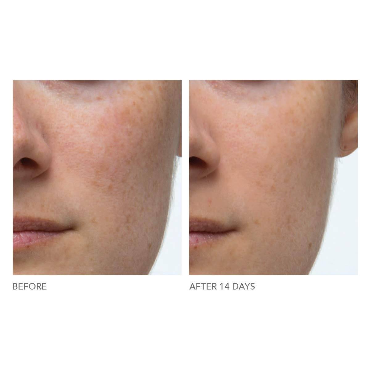 Alpha Beta Extra Strength Daily peel -Take the peel challenge set