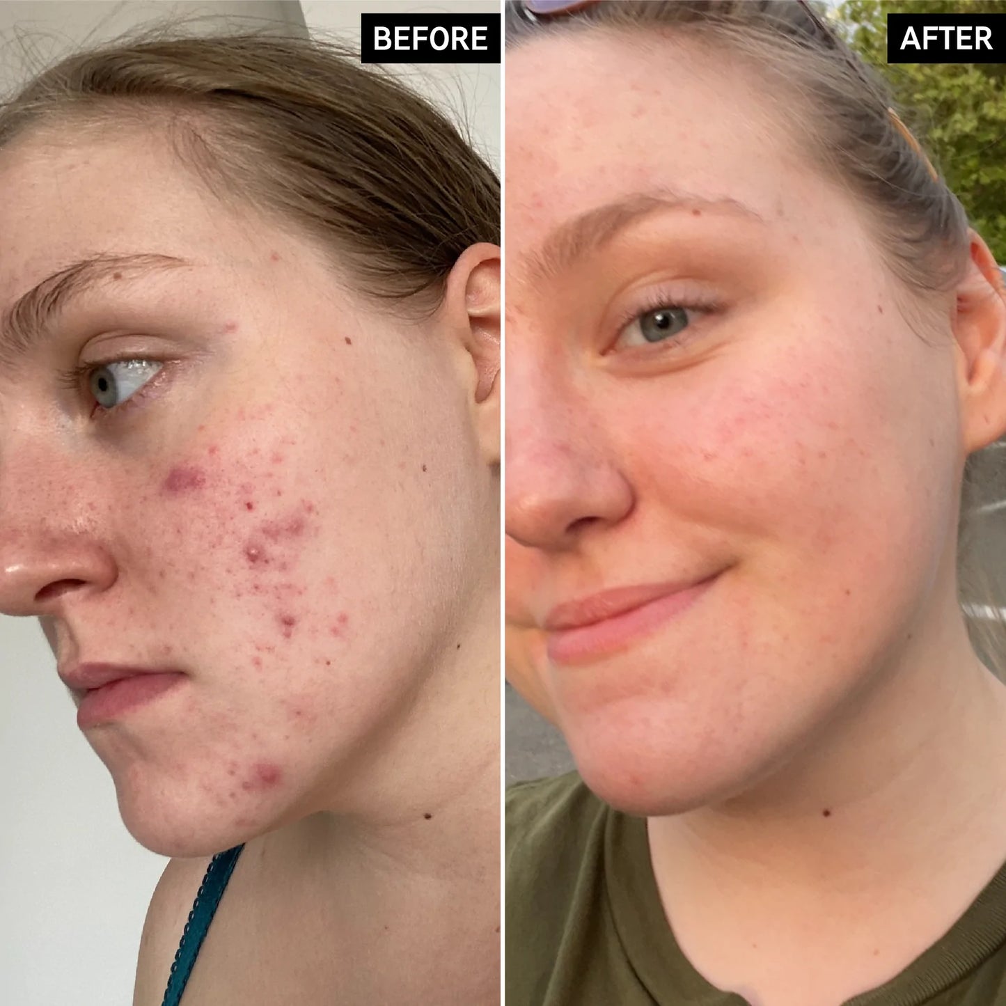 Glycolic Acid Exfoliating Toner - 3.4 oz (Tónico exfoliante)