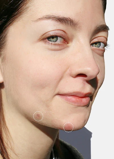 Parches anti acne Skin Invisible