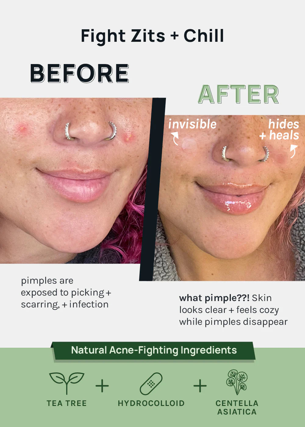 Parches anti acné Skin Invisible