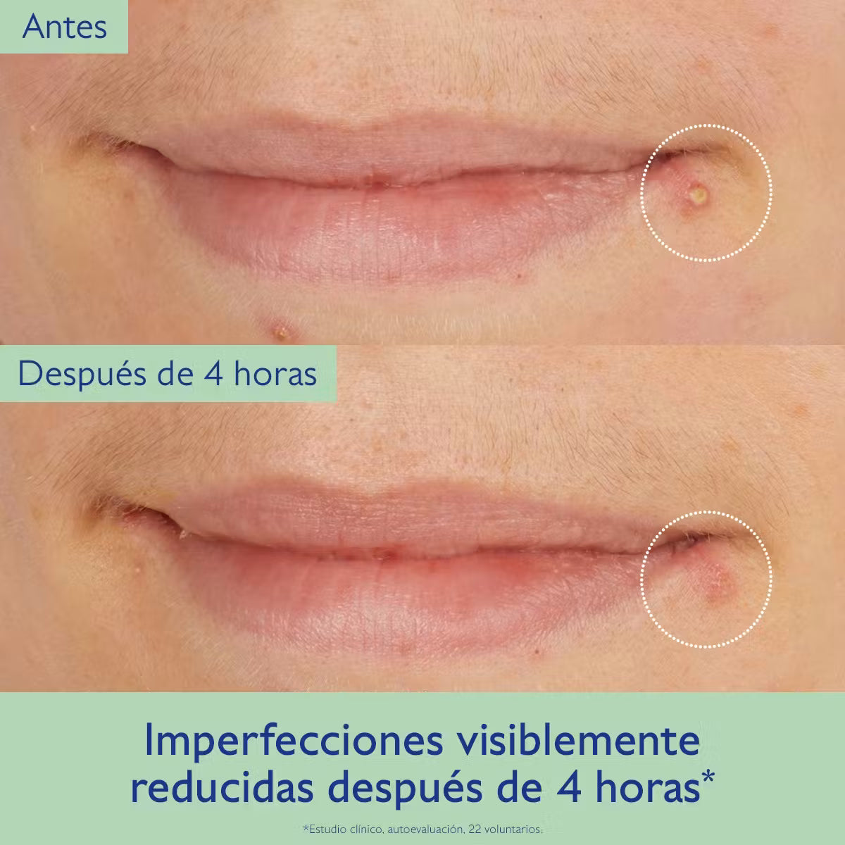 Vinopure Tratamiento de Ácido Salicīlico Natural