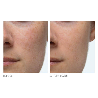 Alpha Beta Extra Strength Daily peel -Take the peel challenge set