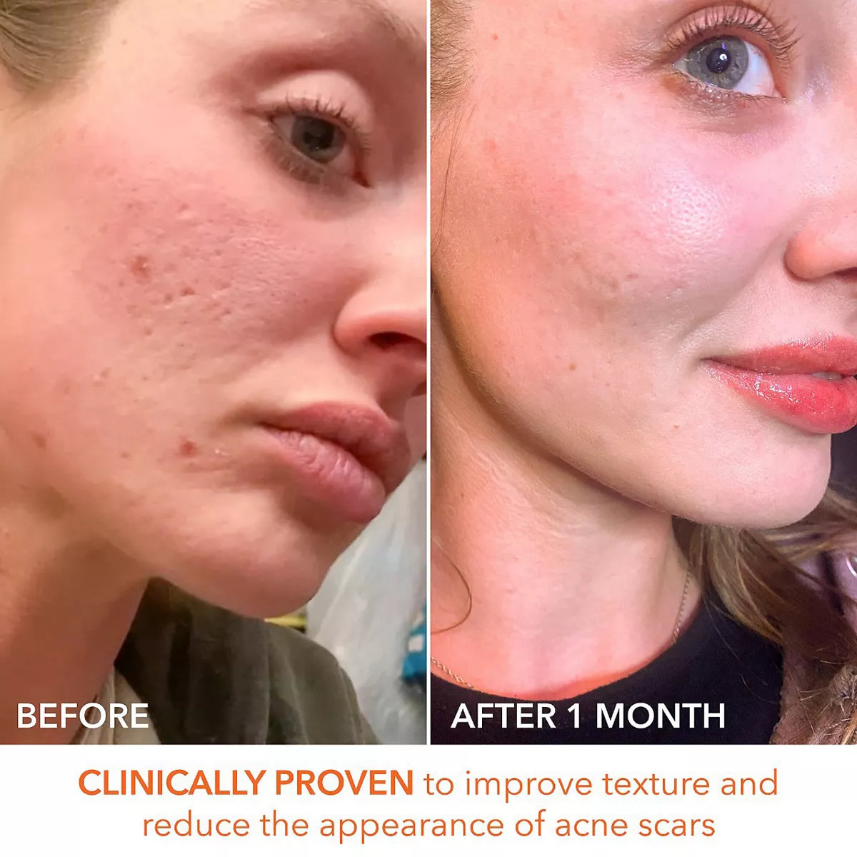 Alpha Beta Extra Strength Daily peel -Take the peel challenge set