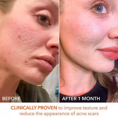 Alpha Beta Extra Strength Daily peel -Take the peel challenge set