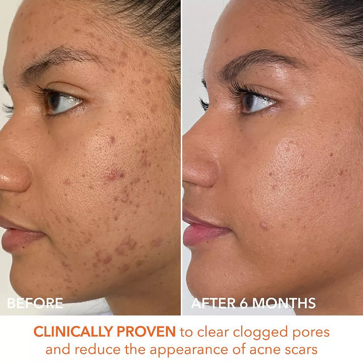 Alpha Beta Extra Strength Daily peel -Take the peel challenge set